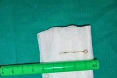 Extraen con éxito un alfiler del pulmón de una niña en el Ineram
