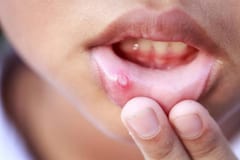 ¿Te salen “fuegos” en la boca? Estas pueden ser las causas