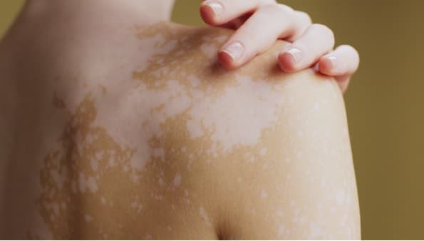 Día Mundial del Vitiligo: qué dice la ciencia sobre sus causas
