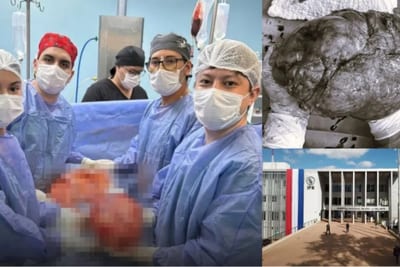 Extirpan tumor de 14 kilos en hospital del IPS