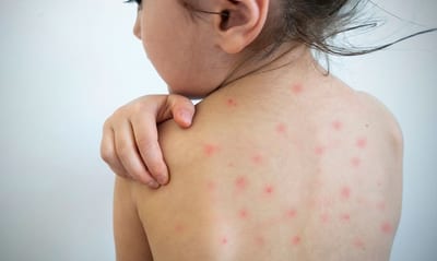 Sarampión: instan a completar vacunación antes de vacaciones