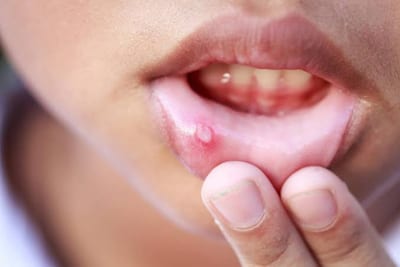 ¿Te salen “fuegos” en la boca? Estas pueden ser las causas