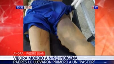 Niño en grave estado tras ser mordido por una víbora