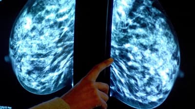 Radioterapia contra el cáncer de mama: beneficios a largo plazo