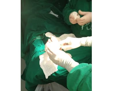 Tratamiento con larvas evita amputaciones en pacientes diabéticos